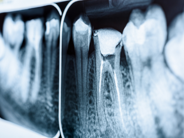 man smiling in dentist exam chair | root canals wilmington de