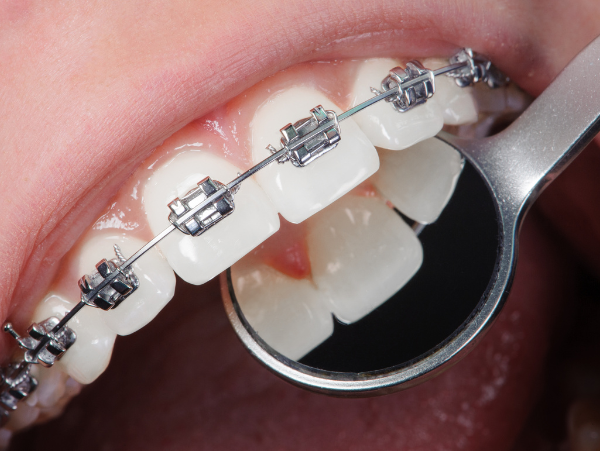 young woman with braces l wilmington de dentist