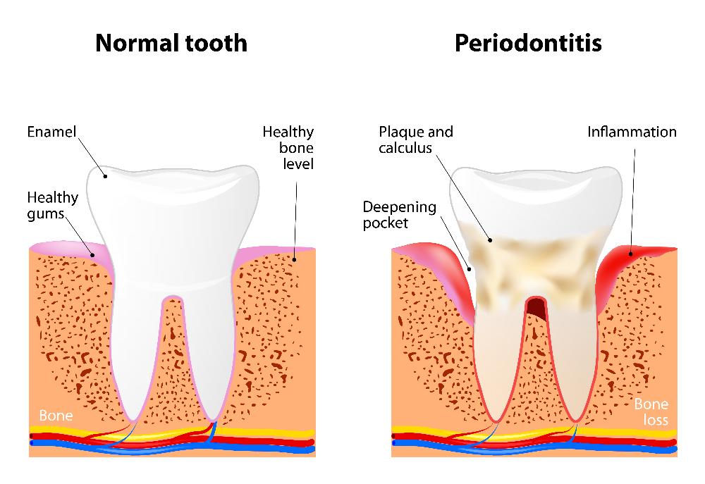 image of gum disease infection | gum disease wilmington