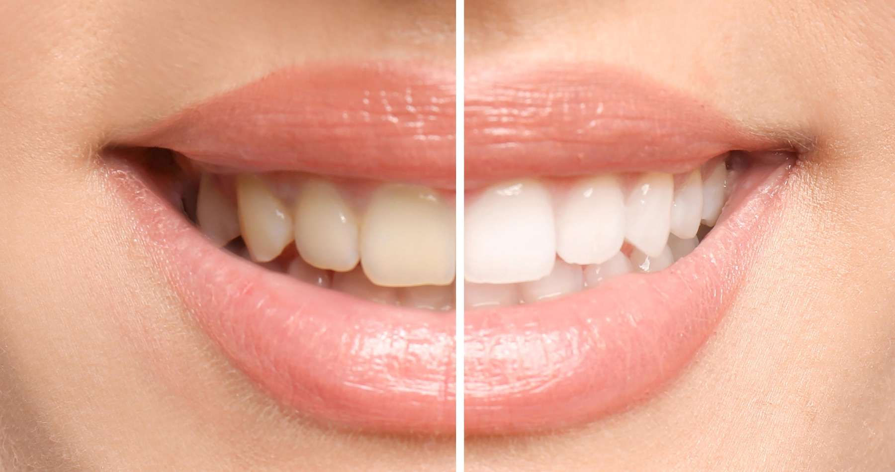 Teeth whitening before and after example