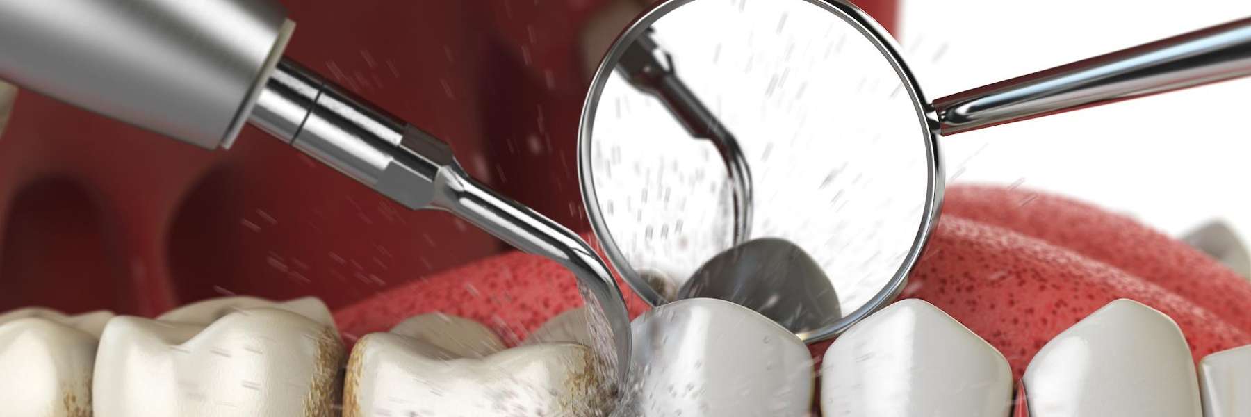 An illustration of a dental cleaning