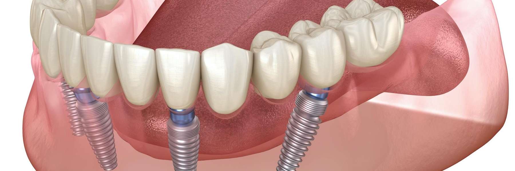 Dental implant screw diagram | dental implants Wilmington DE