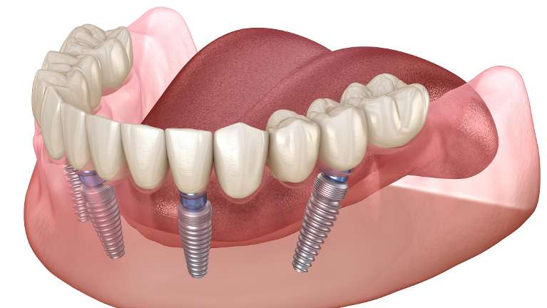 Dental implants diagram | Tooth replacement Wilmington DE
