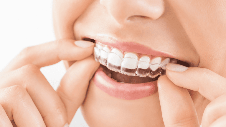 A woman putting in her Invisalign tray | Invisalign Wilmington