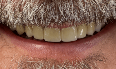 After treatment - Dental Crown