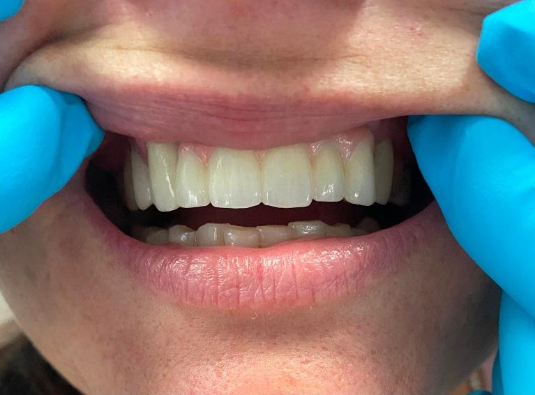 Dental-Implants-Restore-Woman-s-Smile-After-Image