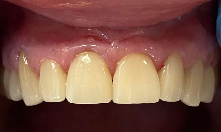 Wilmington veneers- after photo