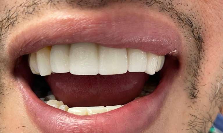 Rescuing-a-patient-with-an-older-dental-implant-After-Image