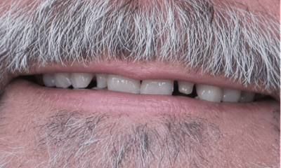 Before treatment - Dental Crown