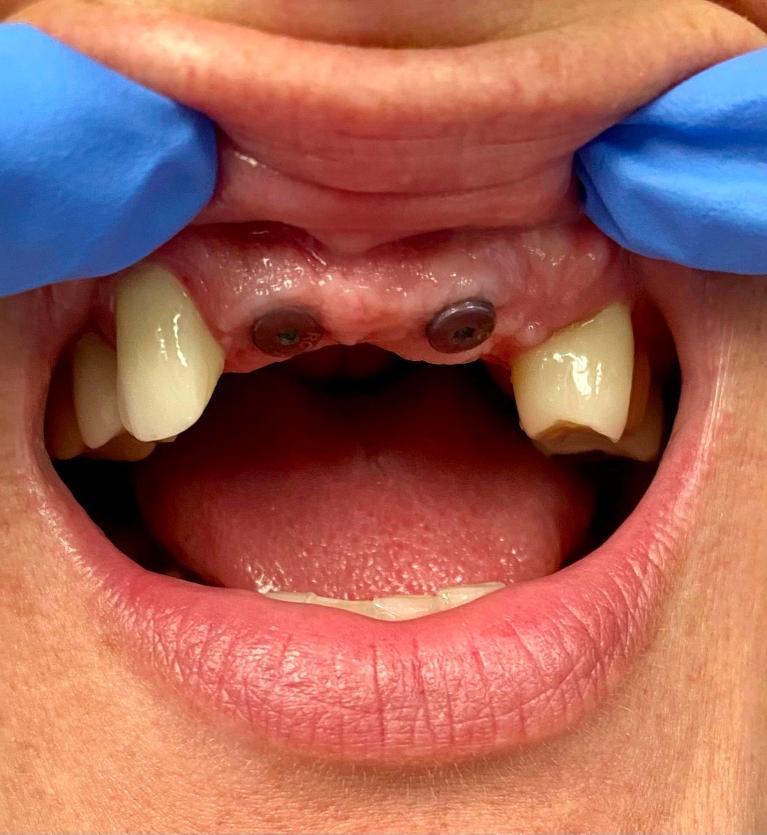 Dental-Implants-Restore-Woman-s-Smile-Before-Image
