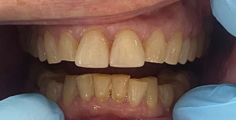Wilmington veneers- before photo