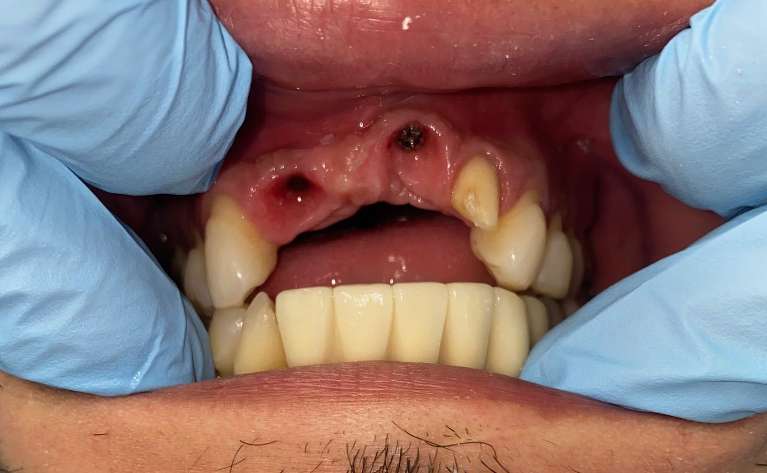 Rescuing-a-patient-with-an-older-dental-implant-Before-Image