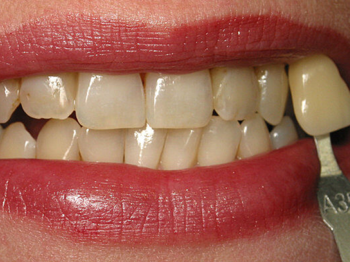 Patient smile before treatment at Justison and Gladnick Family Dentistry