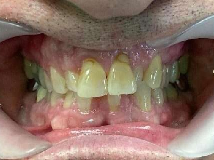 Patient smile before treatment at Justison and Gladnick Family Dentistry